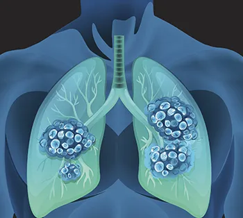 Why Is Lung Cancer Research Underfunded?